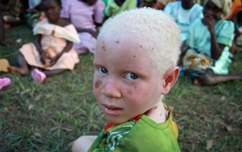 Альбиносы в Танзании