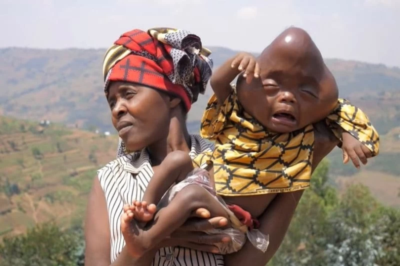 Родственники отказались от африканки, которая родила малыша с головой в форме груши