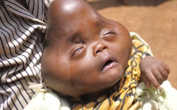 Родственники отказались от африканки, которая родила малыша с головой в форме груши