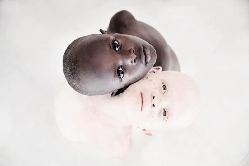 Смертельная белизна: невероятные портреты альбиносов Танзании