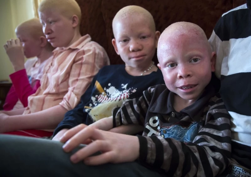 Танзанийские альбиносы, чьи тела стоят дороже золота