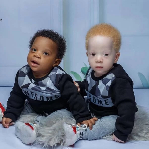 В чем секрет близнецов с разным цветом кожи из Нигерии