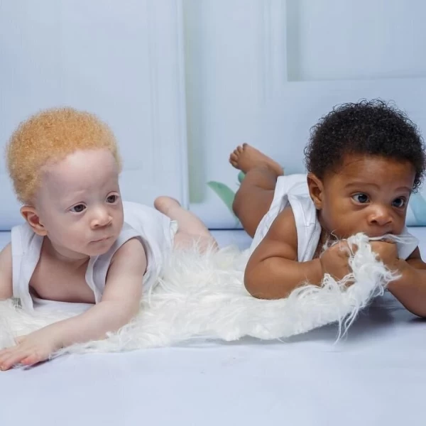 В чем секрет близнецов с разным цветом кожи из Нигерии